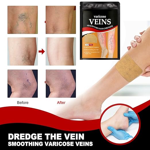 Varicose Veins Sticker for Legs, Against Spider Veins Patch(PACK 1)